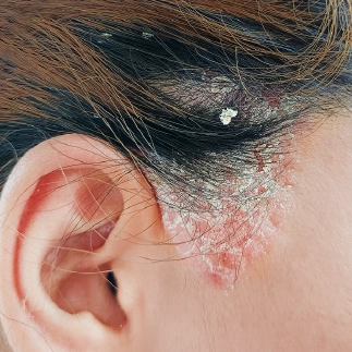 advanced scalp analysis for dandruff treatment